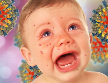 Профилактика кори Preventing measles Прафілактыка адзёру