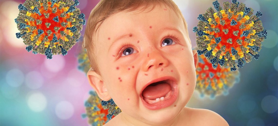 Профилактика кори Preventing measles Прафілактыка адзёру