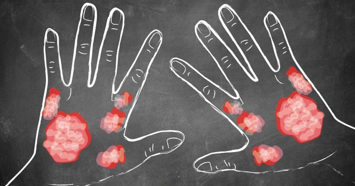 Всемирный день борьбы с псориазом Всемирный день борьбы с псориазом