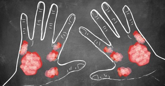 Всемирный день борьбы с псориазом